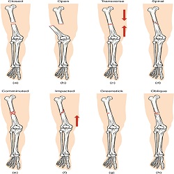 Fractures